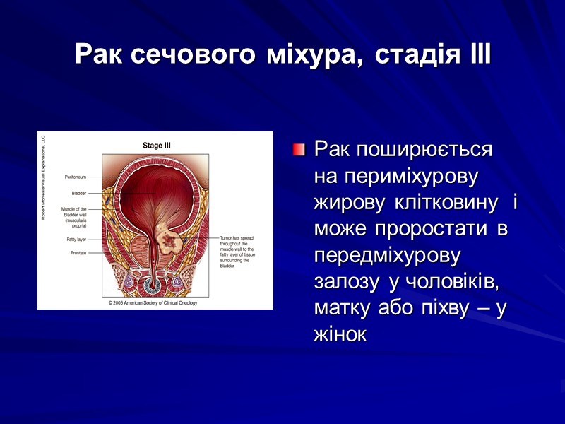 Рак поширюється на периміхурову жирову клітковину  і може проростати в передміхурову залозу у